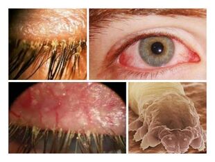 príznaky prítomnosti parazitov pod ľudskou pokožkou